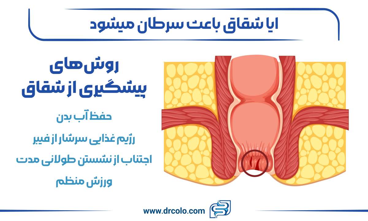 درمان گیاهی زخم مقعدی +معجزه درمان شقاق مقعد