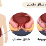 تفاوت شقاق و بواسیر