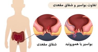 تفاوت شقاق و بواسیر