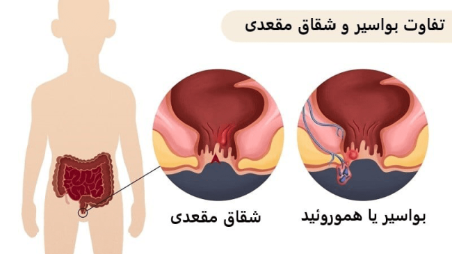 روش‌هاي پیشگیری از بواسیر و شقاق و راه درمان