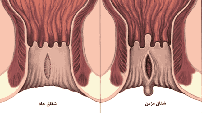 انواع شقاق و آنچه باید بدانید