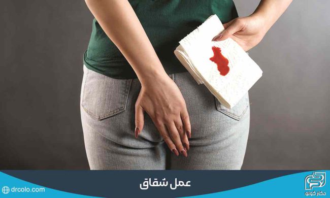عمل شقاق مقعدی: روش‌های نوین و تخصصی درمان